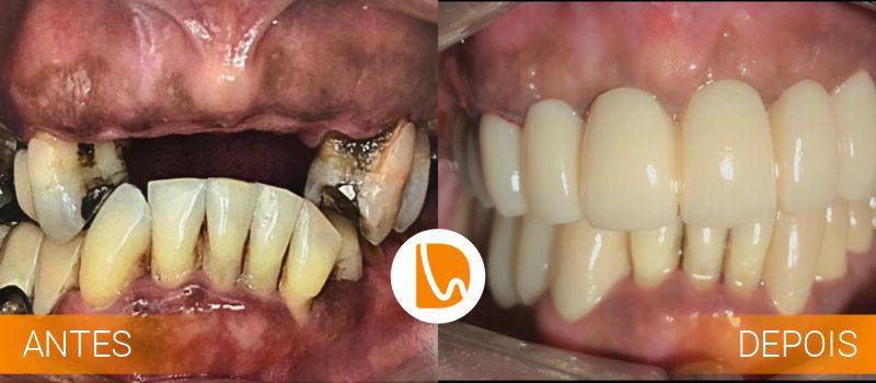 Implante Dentário com Cirirgia Guiada
